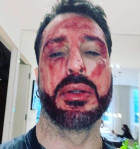 Revoca della pena domiciliare Fabrizio Corona appare col volto insanguinato 